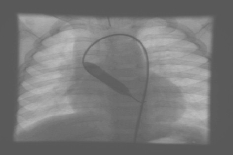 desgarro_arteria_femoral/valvuloplastia_aortica_balon