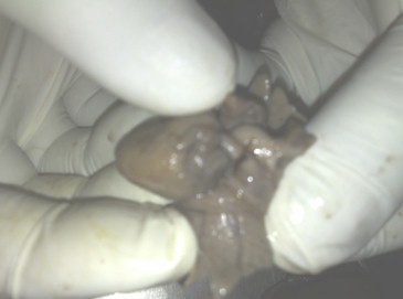 hidrops_fetalis_no_inmunologico/coartacion_aortica_aorta hidrops_fetalis_no_inmunologico/coartacion_aortica_aorta