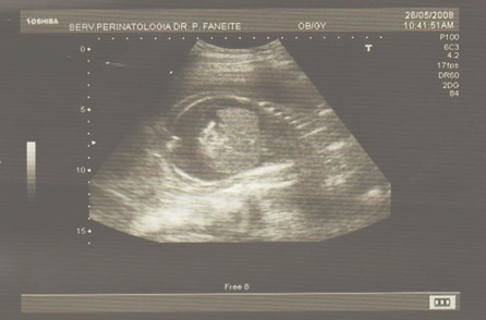hidrops_fetalis_no_inmunologico/ecocardiograma_derrame_pericardico hidrops_fetalis_no_inmunologico/ecocardiograma_derrame_pericardico