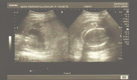 hidrops_fetalis_no_inmunologico/ecografia_ascitis_fetal hidrops_fetalis_no_inmunologico/ecografia_ascitis_fetal