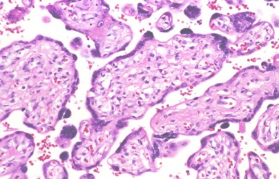 _hidrops_fetalis_no_inmunologico/histologia_anatomia_patologica _hidrops_fetalis_no_inmunologico/histologia_anatomia_patologica