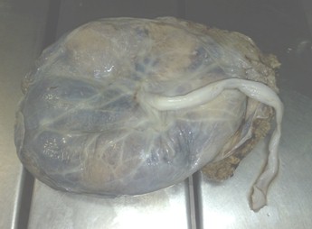 hidrops_fetalis_no_inmunologico/placenta_decidua_decidual hidrops_fetalis_no_inmunologico/placenta_decidua_decidual