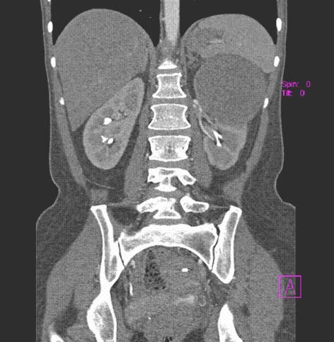hipernefroma_quiste_renal/TAC_abdominal_contraste