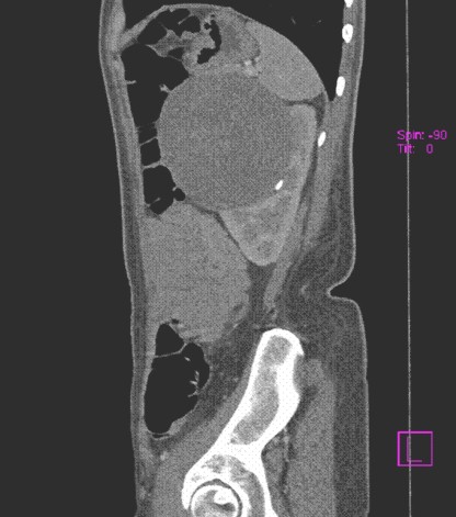 hipernefroma_quiste_renal/TAC_abdominal_sagital