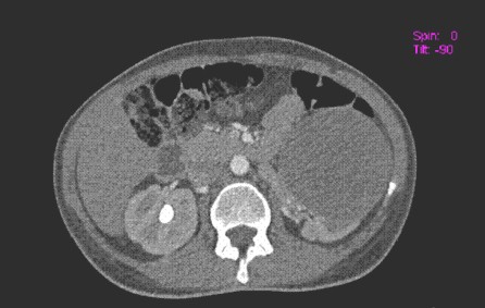 hipernefroma_quiste_renal/TAC_abdominal_scanner