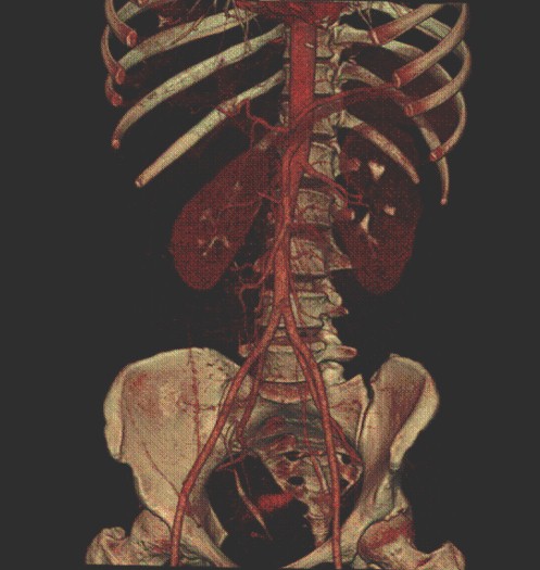 hipernefroma_quiste_renal/angioTAC_reconstruccion_3D