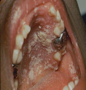 manifestaciones_cutaneomucosas_SIDA/candida_candidiasis_oral