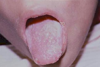 manifestaciones_cutaneomucosas_SIDA/candidiasis_oral_candida