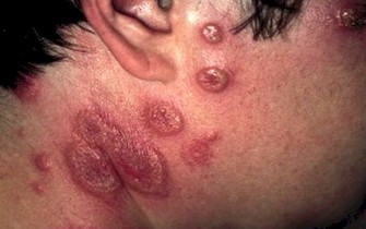 manifestaciones_cutaneomucosas_SIDA/sindrome_sweet_HIV manifestaciones_cutaneomucosas_SIDA/sindrome_sweet_HIV