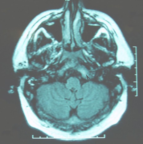 paralisis_unilateral_hipogloso/RMN_cerebral_axial