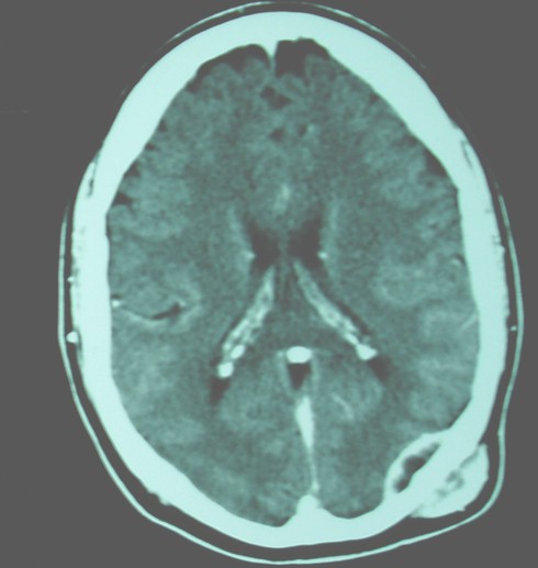 paralisis_unilateral_hipogloso/TAC_cerebral_lesiones paralisis_unilateral_hipogloso/TAC_cerebral_lesiones