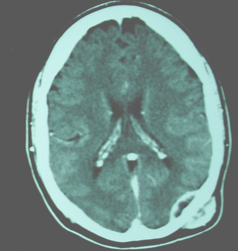 paralisis_unilateral_hipogloso/TAC_cerebral_lesiones