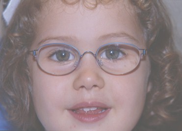 problemas_visuales_infancia/defecto_refractivo problemas_visuales_infancia/defecto_refractivo