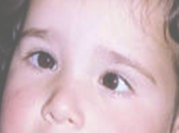 problemas_visuales_infancia/estrabismo_estrabico_estrabica problemas_visuales_infancia/estrabismo_estrabico_estrabica