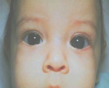 problemas_visuales_infancia/glaucoma_congenito