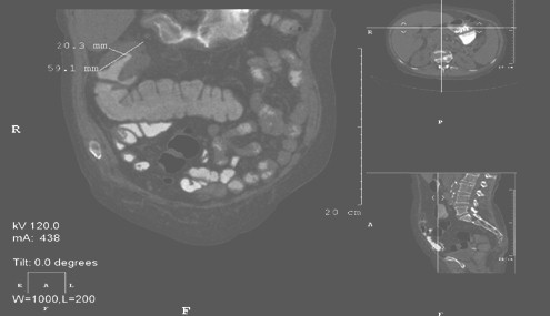 tomografia_endoscopia_tumores/TAC_adenocarcinoma_colon tomografia_endoscopia_tumores/TAC_adenocarcinoma_colon
