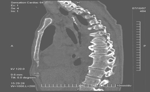 tomografia_endoscopia_tumores/TAC_adenocarcinoma_gastrico