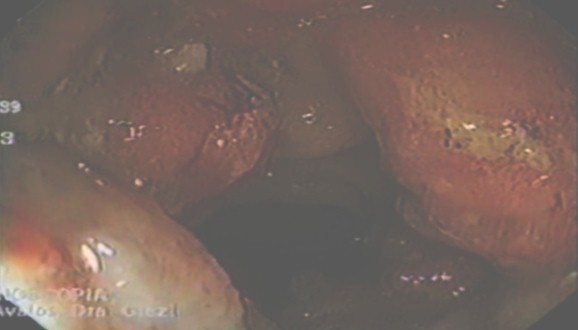 tomografia_endoscopia_tumores/colonoscopia_adenocarcinoma_colon