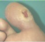 tratamiento_ulceras_presion/ulcera_neuropatica tratamiento_ulceras_presion/ulcera_neuropatica