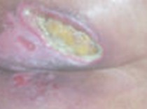 tratamiento_ulceras_presion/ulcera_por_presion_UPP tratamiento_ulceras_presion/ulcera_por_presion_UPP