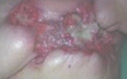 tratamiento_ulceras_presion/ulcera_tumoral_mamaria tratamiento_ulceras_presion/ulcera_tumoral_mamaria