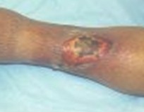 tratamiento_ulceras_presion/ulcera_vascular_arterial tratamiento_ulceras_presion/ulcera_vascular_arterial