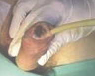 tratamiento_ulceras_presion/ulcera_yatrogenica_iatrogenica tratamiento_ulceras_presion/ulcera_yatrogenica_iatrogenica
