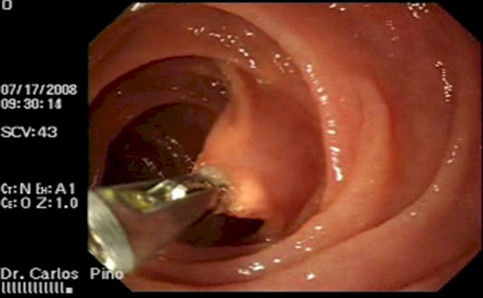 tumor_duodeno_caso/biopsia_endoscopia_muestra tumor_duodeno_caso/biopsia_endoscopia_muestra