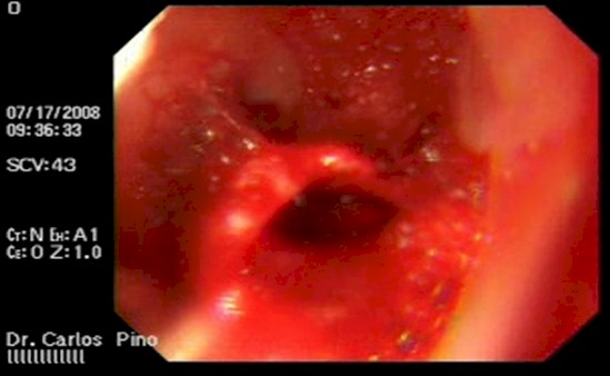 tumor_duodeno_caso/endoscopia_esofagoscopia_gastroscopia
