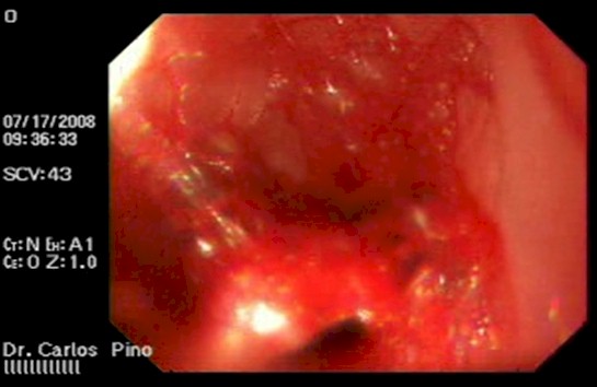 tumor_duodeno_caso/lesion_vascular_duoden tumor_duodeno_caso/lesion_vascular_duoden