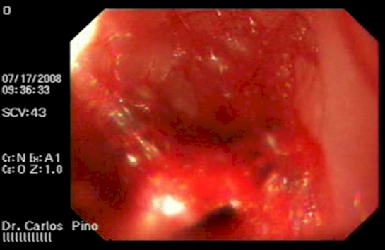 tumor_duodeno_caso/lesion_vascular_duoden