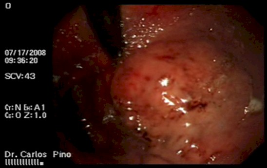 tumor_duodeno_caso/lesiones_hemorragicas_fundus_gastrico