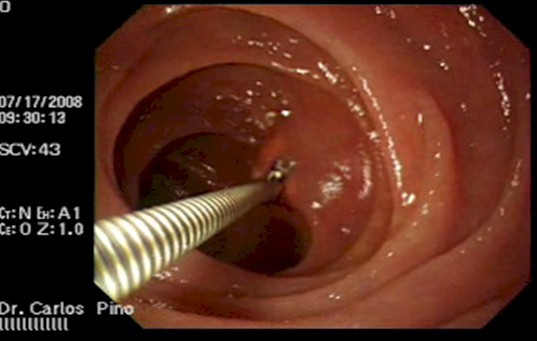 tumor_duodeno_caso/toma_muestra_biopsia tumor_duodeno_caso/toma_muestra_biopsia