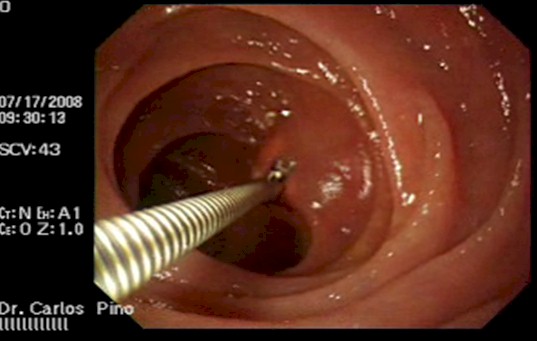 tumor_duodeno_caso/toma_muestra_biopsia