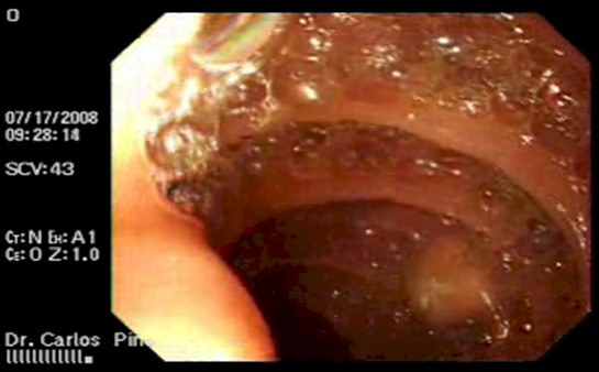 tumor_duodeno_caso/tumor_pediculado_endoscopia