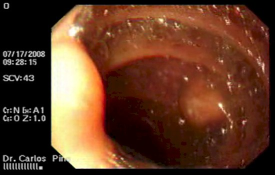 tumor_duodeno_caso/tumor_pediculado_endoscopico