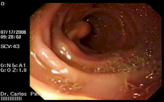 tumor_duodeno_caso/tumor_pediculado_segunda