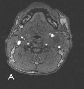 tumor_glomus_carotideo/IRM_RMN_T1_axial tumor_glomus_carotideo/IRM_RMN_T1_axial