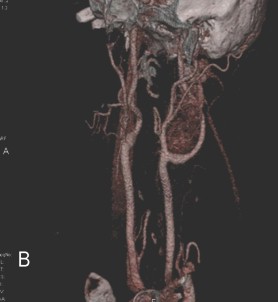 tumor_glomus_carotideo/angioTAC_reconstruccion_VRT