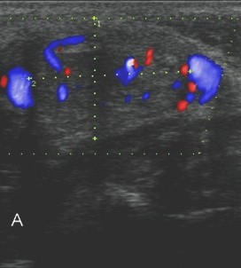 tumor_glomus_carotideo/masa_hipoecoica_eco-Doppler