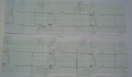 dextrocardia_malposicion_cardiaca/ecg_electrocardiografia