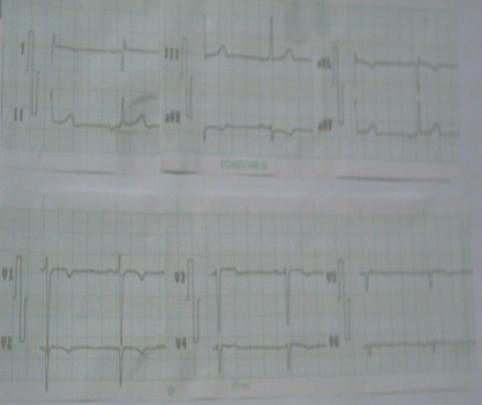 dextrocardia_malposicion_cardiaca/ecg_electrocardiograma