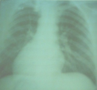 dextrocardia_malposicion_cardiaca/rx_telecardiograma_radiografia