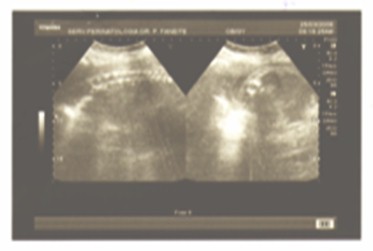 diagnostico_peritonitis_meconial/distension_camara_gastrica