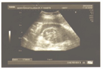 diagnostico_peritonitis_meconial/ecografia_fetal_hidrocele