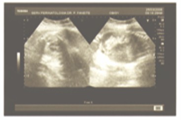 diagnostico_peritonitis_meconial/ecografia_obstruccion_intestinal