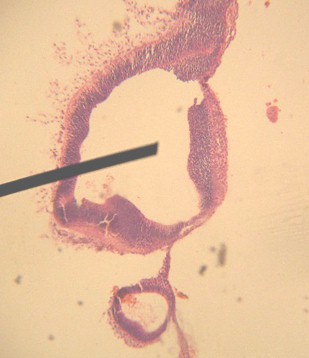 embarazo_ectopico_gemelar/anatomia_patologica_histologia embarazo_ectopico_gemelar/anatomia_patologica_histologia