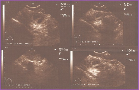 embarazo_ectopico_gemelar/ecografia_abdominal_transvaginal