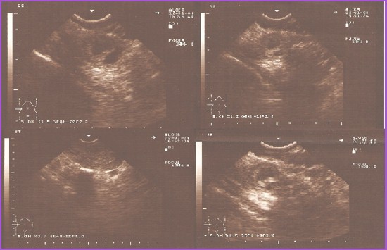 embarazo_ectopico_gemelar/ecografia_abdominal_transvaginal embarazo_ectopico_gemelar/ecografia_abdominal_transvaginal