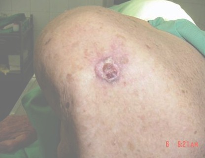 carcinoma_cutaneo_cancer/piel_basocelular_preoperatorio